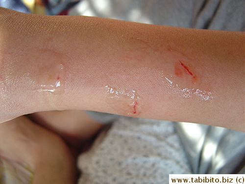 KL's wound was mostly scratches